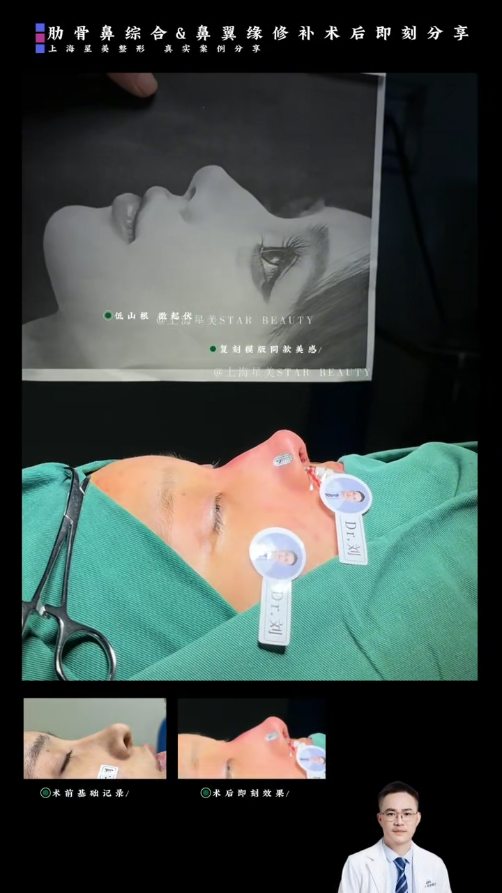 กรณีทันทีหลังการผ่าตัดซ่อมแซมจมูกซี่โครงและจมูก: โปรแกรมรวม "การสนับสนุนปลายจมูก + การลดจมูก"