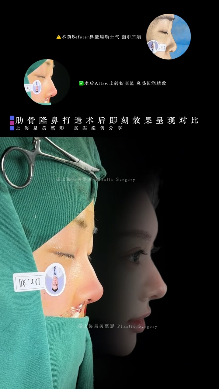 การเปรียบเทียบผลลัพธ์ทันทีหลังการผ่าตัดเสริมจมูกซี่โครง