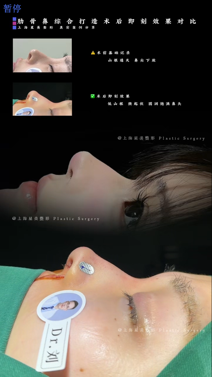 การเปรียบเทียบทันทีหลังการผ่าตัดซินโครมซี่โครงจมูก